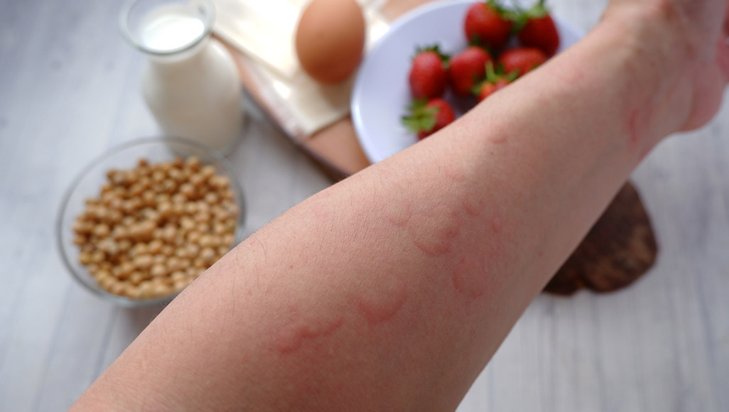 Mutélios le mag online, allergies alimentaires